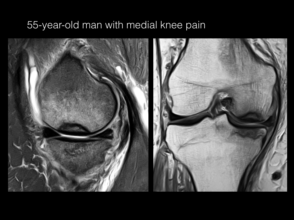 Figure 3 for case stress fracture ( RID4695 ) Osteonecrosis Meniscal Root tear